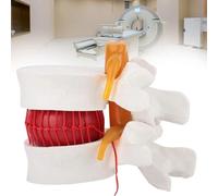 1:1.5 Human Anatomy Lumbar Spine Demonstration Model Spine Lumbar Disc Herniation Model Anatomical Human Spine Model Lumbar Disc Herniation Model