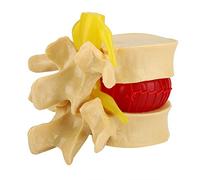 1:1.5 Lumbar Disc Herniation Demonstration Model Study Learn Human Spine
