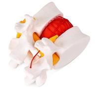 1.5X Enlarged Lumbar Spine Model Human Lumbar Disc Herniation Model Degenerative Lumbar Vertebrae Model for Human Anatomy and Science Education Medical Research