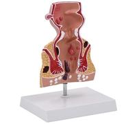 1.5X Human Rectum Model with Common Pathologies, Rectum Model Human Anatomy Model Medicals Teaching Tool, Study and Display