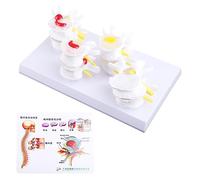 1 Set Human Lumbar Lesion Spine Statue Display Model Medical Teaching Learning F Teaching Models