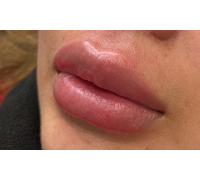 1ml lip dermal filler