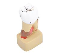 1pc Dental Pathological Disease Caries Study Teaching Tooth Model Resin Shows Periapical Abscess Gingival Bleeding Calculus for Dentist Patient Communication Hygiene Educat