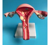1pc Human Pathological Uterus Ovary Model Cross Section Structure Model Uterus Anatomical Anatomy Female Organ Teach Study Tool