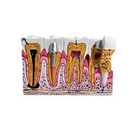 1Pcs Dental Model Caries Anatomy Model Comprehensive Pathology Tooth Nerve Tooth Model Dental Oral Teaching Demo Teeth Model(Type1)