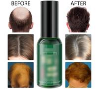 2 Bottles Hair Growth Serum, 30ml/1.05oz Anti-Loss and Hair Growth Serum, Promotes Scalp Health, Strengthens Roots & Prevents Breakage
