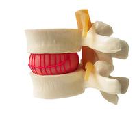 2pcs Anatomical Model Oral Anatomical Human Lumbar Disc Herniation Demonstration Model Human Spine Anatomical Human Spine Sciences Classroom Teaching