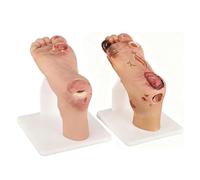 2Pcs Diabetic Foot Ulcer Model Kit, Foot Ulcer Pathology Model, Mild 1~3 Level And Severe 4~5 Level Two-Stage Diabetic Foot Simulator, For Medical Research Training