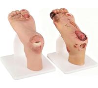 2Pcs Diabetic Foot Ulcer Model Set, Mild 1~3 Level and Severe 4~5 Level Two-Stage Diabetic Foot Anatomical Model, Foot Ulcer Pathology Simulator, for Medical Research