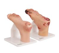 2PCS Educational Diabetic Foot Ulcer Model Set - Anatomical Accuracy for Mild & Severe Stage Pathology Study - Medical Training Tool for Healthcare Professionals