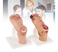 2PCS Educational Diabetic Foot Ulcer Model Set, Purulent Wound Lesions Grade(Mild Disease 1~3Level or Severe 4~5Level), Anatomical Accuracy, for Mild & Severe Stage Pathology Study