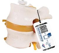 3B Scientific 2 Lumbar Vertebrae with Prolapsed Disc Flexibly Mounted + free anatomy software - 3B Smart Anatomy