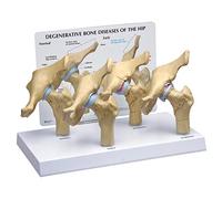 3B Scientific 4-Stage Degenerative Bone Diseases of the Hip Model