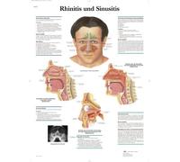 3B Scientific Anatomical Chart 'Rhinitis und Sinusitis' ('Rhinitis and Sinusitis') in German Language
