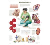 3B Scientific Chart Hypertension, 1