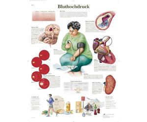 3B Scientific Chart Hypertension, 1