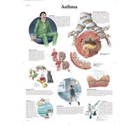 3B Scientific Chart Laminated Asthma, 1