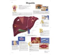 3B Scientific Chart Laminated Hepatitis, 1