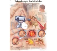 3B Scientific Chart Laminated Mediumear Diseases, 1