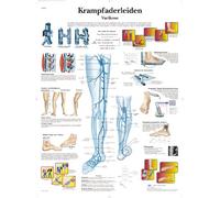 3B Scientific Chart Laminated Varicosis Varicosis, 1