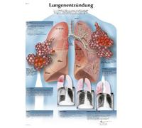 3B Scientific Chart Laminated with Pneumonia, 1