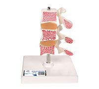 3B Scientific Deluxe Osteoporosis Model 3 Vertebrae + free Anatomy App - 3B Smart Anatomy