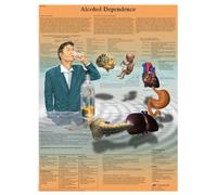 3B Scientific Human Anatomy - Alcohol Dependence Chart, Laminated Version