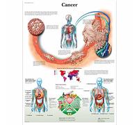 3B Scientific Human Anatomy - Cancer Chart, Paper Version