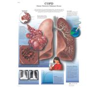3B Scientific Human Anatomy - Chronic Obstructive Pulmonary Disease Chart, Laminated Version