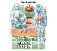 3B Scientific Human Anatomy - Diabetes mellitus Chart, Laminated Version