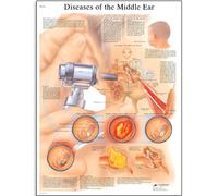 3B Scientific Human Anatomy - Diseases of the Middle Ear Chart, Paper Version