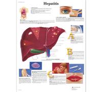 3B Scientific Human Anatomy - Hepatitis Chart, Laminated Version