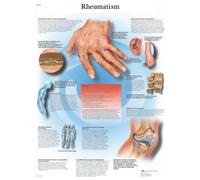 3B Scientific Human Anatomy - Rheumatic Diseases, Laminated Version