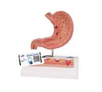 3B Scientific K17 Stomach With Ulcers + free Anatomy App - 3B Smart Anatomy