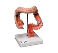 3B Scientific K55 Intestinal Diseases + free anatomy software - 3B Smart Anatomy