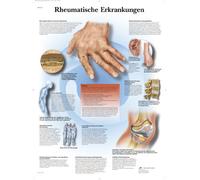 3B Scientific Leather board laminated - Rheumatic diseases