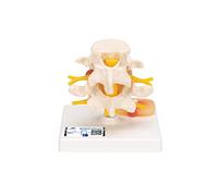 3B Scientific Lumbar Spinal Column with Prolapsed InterVertebral Disc + free anatomy software - 3B Smart Anatomy