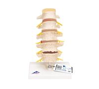 3B Scientific Stages of Disc prolapse and Vertebral Degeneration + free anatomy software - 3B Smart Anatomy A795