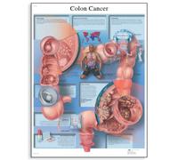 3B Scientific VR1432UU Human Anatomy Colon Cancer Chart, Paper Version