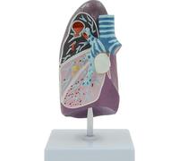 3D Lung Cancer Model Pathology Lung Model, Human Lung Anatomical Model, Clear Texture & Accurate Anatomy Structure for Medical School Study, Research and Doctor-Patient Communication