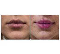 3ml - Dermal Filler Facial Contouring Package - with Consultation