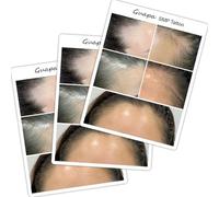 3PCS/Pack Scalp Micropigmentation Practice Skin - Printed SMP Tattoo Training Pad for Hairline Design & Dot Work - Ideal for Beginners & Artists (3PCS Design #2)