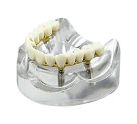 4 Implants Teeth Model Restoration Removable Overdenture Silver Model For Researching Medical Dentist Students Learning Demo(Implant golden upper)