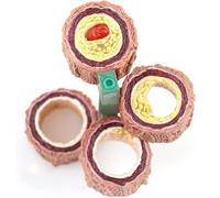 4-Piece Artery Model, Atherosclerosis Model with Plaque Build Up,Human Artery Blood Vessel Anatomy Model,Anatomy Model for Doctor's Offices and Classrooms