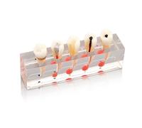 4-Stage Endodontic Treatment Model for Studing Teaching Teeth Model Doctor-Patient Communication Model