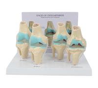 4-stage Knee Joint Disease Model PVC Life Size Lesion Knee Joint Model Osteoarthritis Anatomical Model with Back Card and Display Base for Study Display Teaching