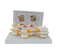 4-Stage Lumbar Spine Pathology Comparison Model with Instruction Card