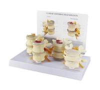 4-Stage Vertebrae Model, Comparative Model of 4-Stage Lesion Lumbar Spine,Spine Model for Human Anatomy and Physiology Education, Bone & Disc Degeneration, Orthopaedic Teaching Display Aids