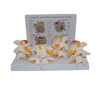 4-Stage Vertebrae Spine Model, Human Anatomy and Physiology Education Tool for Doctors and Classrooms