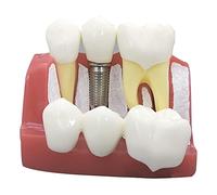 4 Times Dental Implant Model Removable Analysis Crown Bridge Demonstration Teeth Model